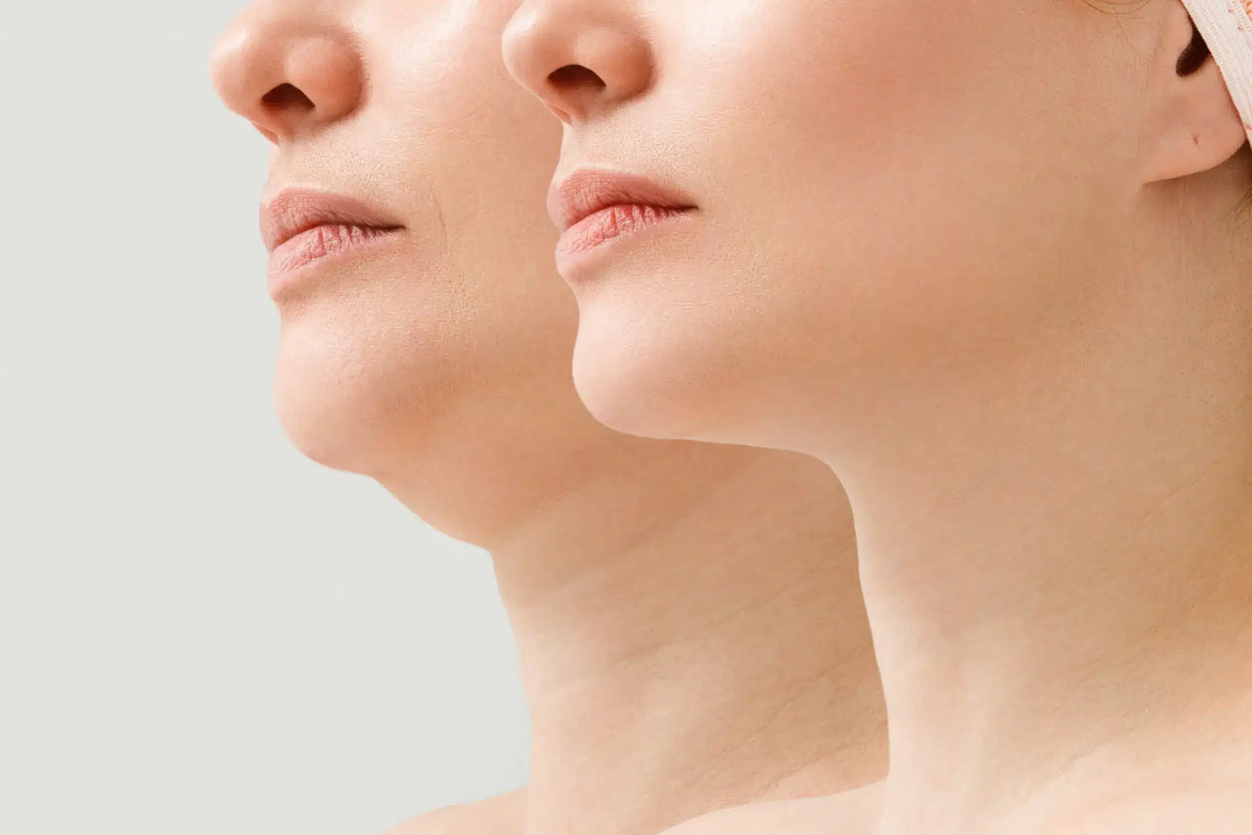 Facelift marketing agency strategy reaching younger, technique-aware facial rejuvenation patients across search and AI