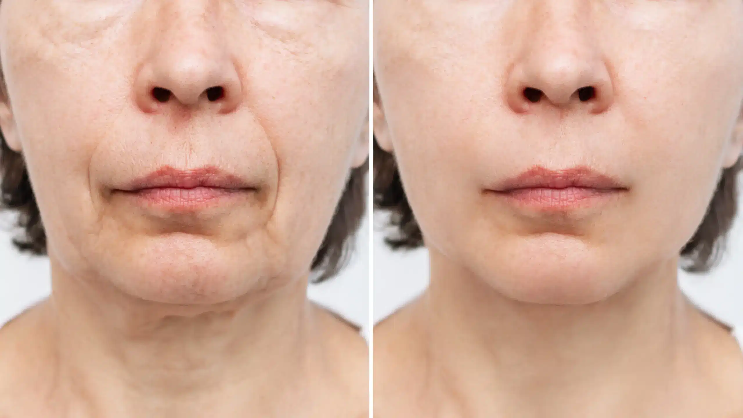 Facelift marketing services showcasing before-and-after results categorized by technique and age to build patient trust